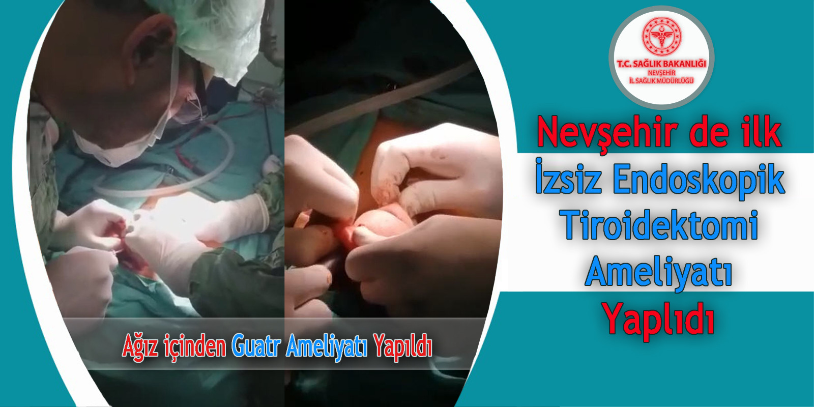 Nevşehir’de Bir İlk İzsiz Endoskopik Tiroidektomi (Ağız içinden Guatr Ameliyatı) Yapıldı